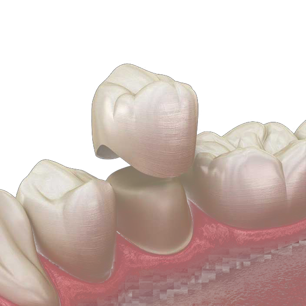 انواع روکش دندان