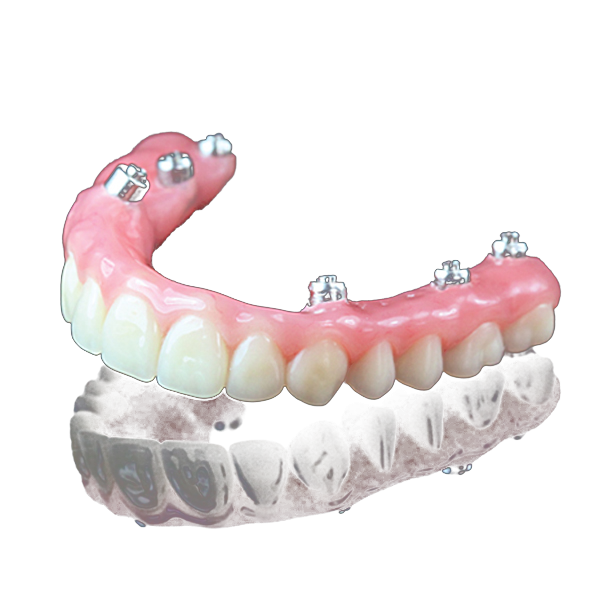 اوردنچر متکی بر ایمپلنت